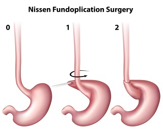 Le Nissen sleeve pour perdre du poids et traiter l'obésité à Namur