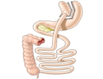 Bypass gastrique