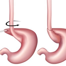 Le Nissen Sleeve en chirurgie de l’obésité à Namur